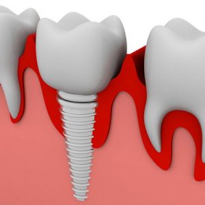Implants as long term companions