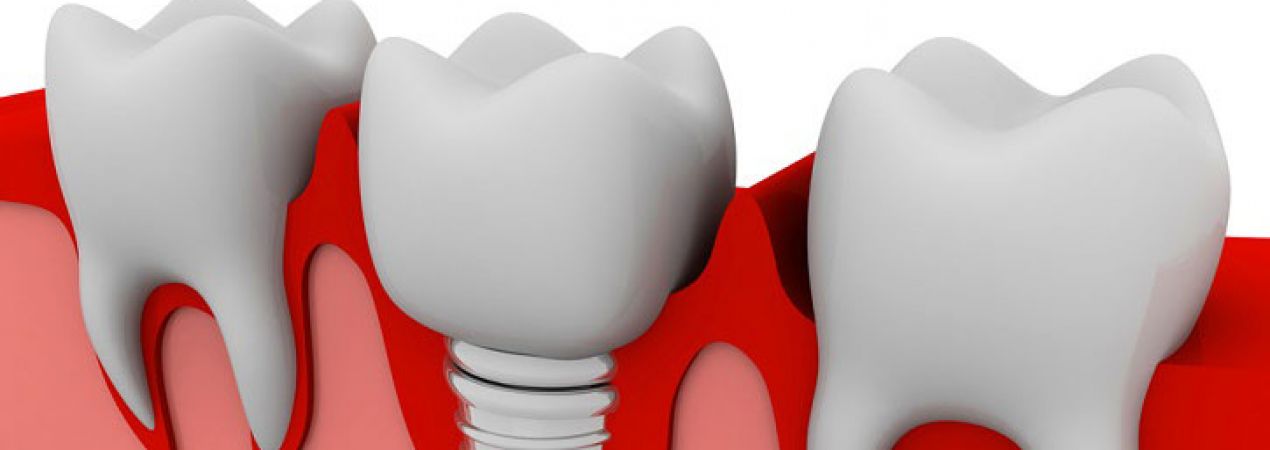 Implants as long term companions